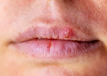 8 Cara Untuk Mengatasi Bibir Kering Secara Alami