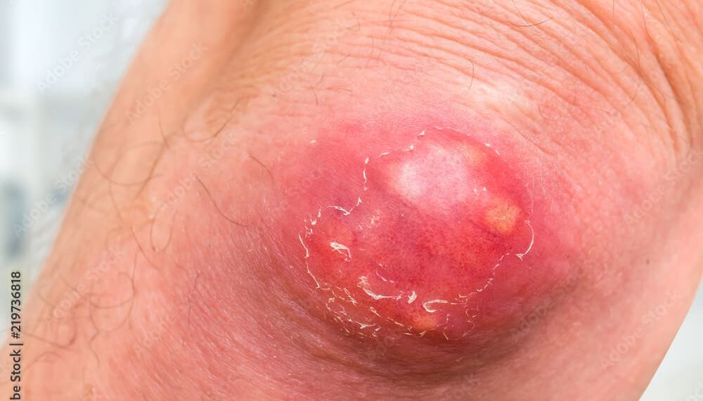 Tidak Benar! Mitos Telur Bikin Bisul Ternyata Salah Besar