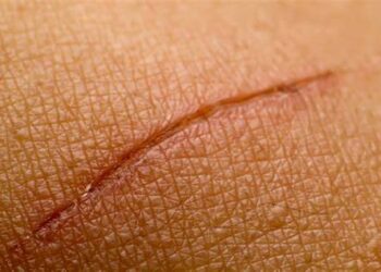 5 Tips Mempercepat Menghilangkan Bekas Luka