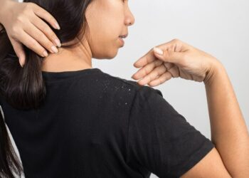 6 Cara Alami Menghilangkan Ketombe Kering Di Kulit Kepala