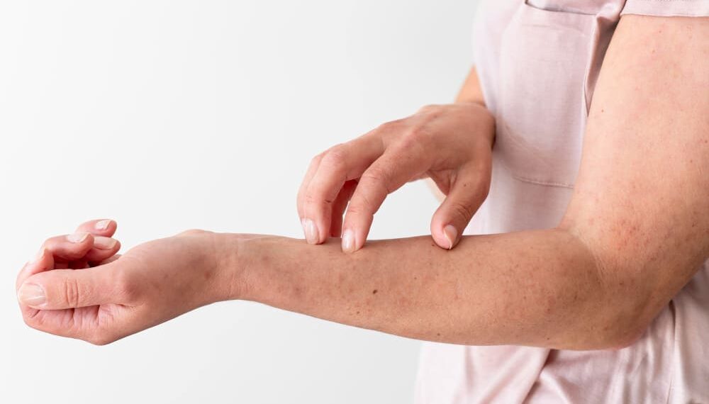 Biduran Akibat Makan Seafood? Kok Bisa?