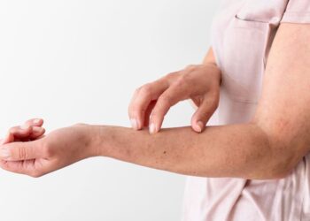 Biduran Akibat Makan Seafood? Kok Bisa?